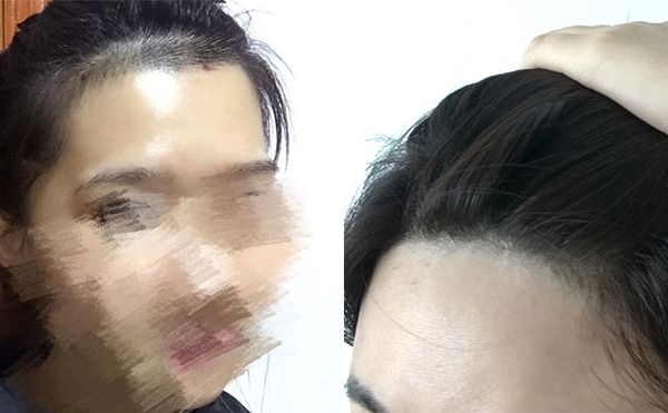 冰點面部脫毛有沒有疼痛感？