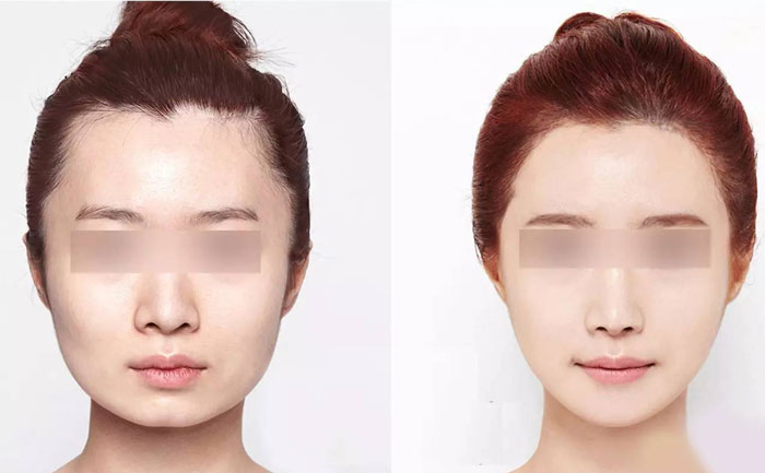 臉部咬肌肥大怎么瘦？臉部咬肌肥大如何去除？