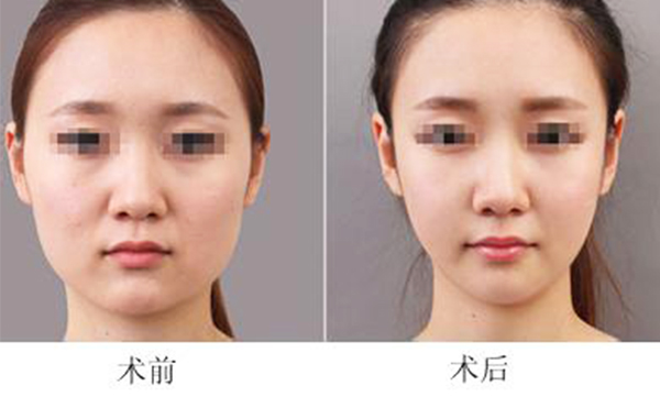 面部吸脂會(huì)導(dǎo)致臉下垂嗎？