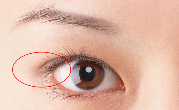 開外眼角價(jià)格多少錢?開外眼角術(shù)后怎么護(hù)理?