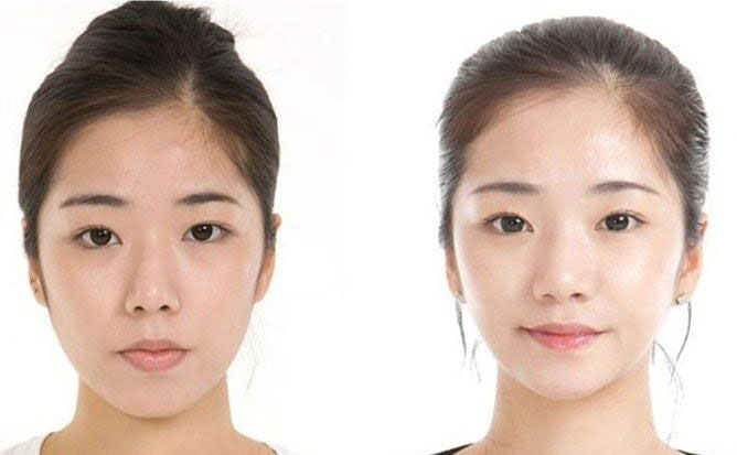 面部吸脂瘦臉的副作用？