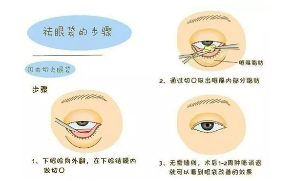 內切去眼袋安全性怎么樣?內切去眼袋會復發(fā)嗎?