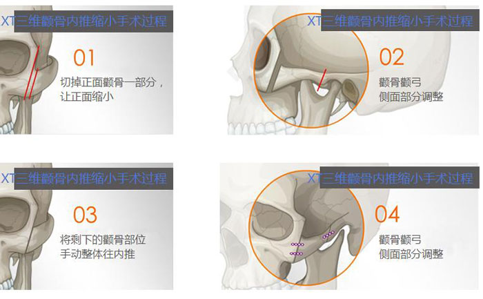 額骨內(nèi)推是什么手術(shù)？