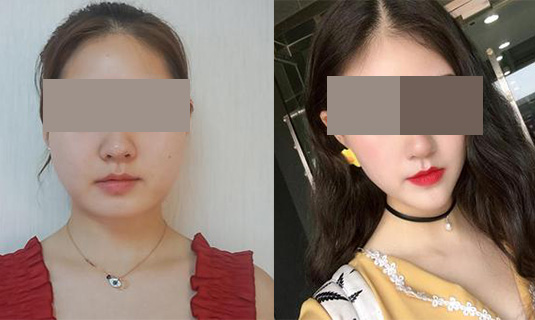 面部吸脂效果對(duì)比圖