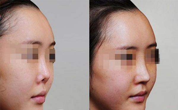 修復(fù)后的鼻翼缺損是否真實(shí)？
