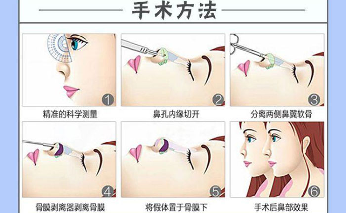 隆鼻假體取出后能恢復(fù)到以前嗎？
