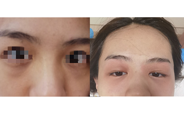 光子嫩膚去黑眼圈怎么樣？