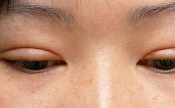 埋線雙眼皮失敗該如何修復？多久修復好？