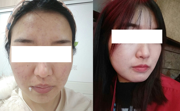 美白針可以維持多久？