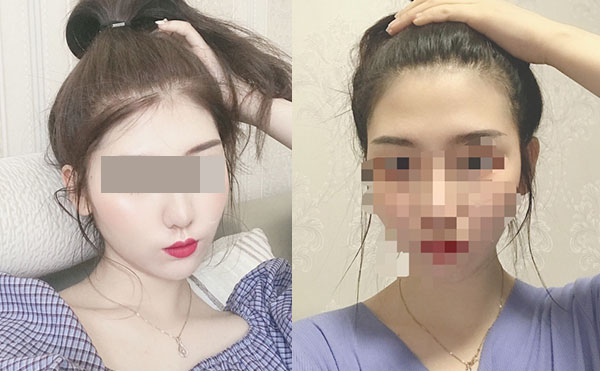 冰點(diǎn)脫毛后多久可以洗澡嗎？