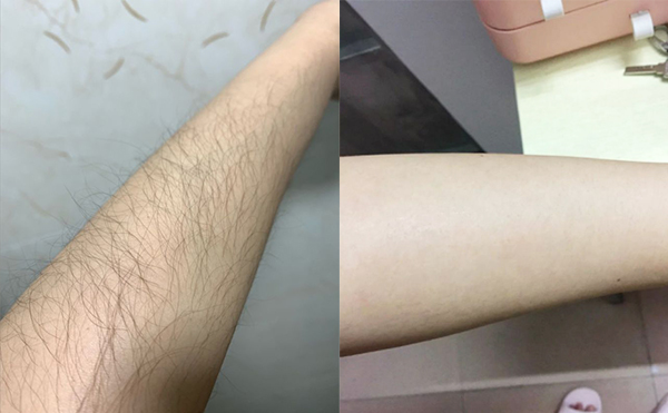 光子手臂脫毛是怎么做的？