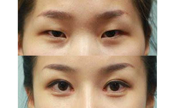 眼綜合手術(shù)多久能恢復(fù)自然？