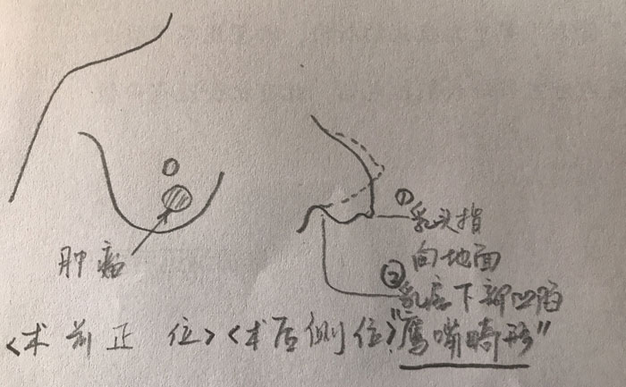 乳房畸形是什么原因造成的？乳房畸形矯正手術(shù)方法？