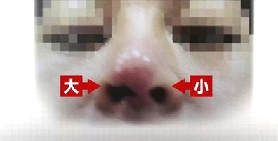 隆鼻手術(shù)