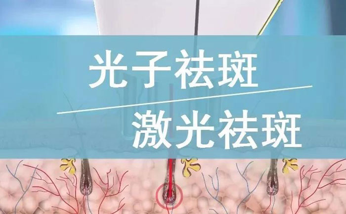 光子祛斑效果如何？