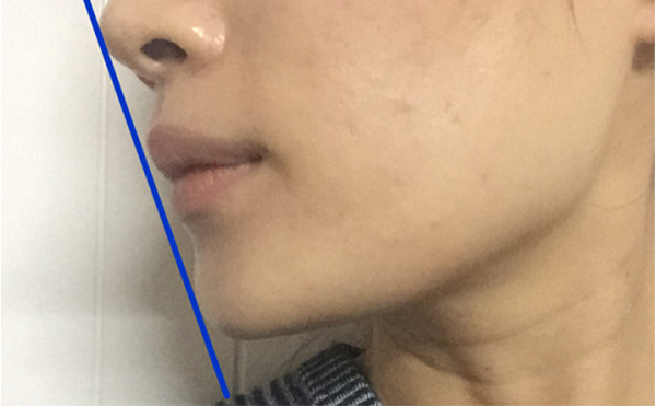 做假體墊下巴恢復(fù)后會(huì)被摸出來做過嗎？還能打玻尿酸嗎？