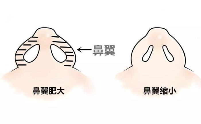鼻翼縮小手術(shù)要做多久？