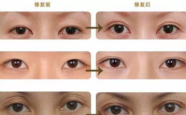 雙眼皮修復(fù)可靠嗎？什么時(shí)候做雙眼皮修復(fù)比較好？
