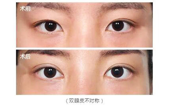 雙眼皮修復(fù)的最佳時間是什么時候?價錢貴不貴?