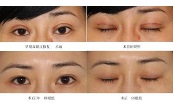 雙眼皮修復恢復快嗎?哪些人不適合做雙眼皮修復?