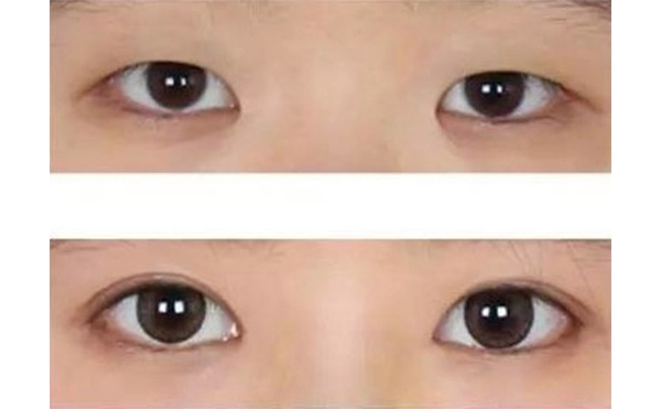 多大年紀適合做水泡眼矯正術(shù)?效果好不好?