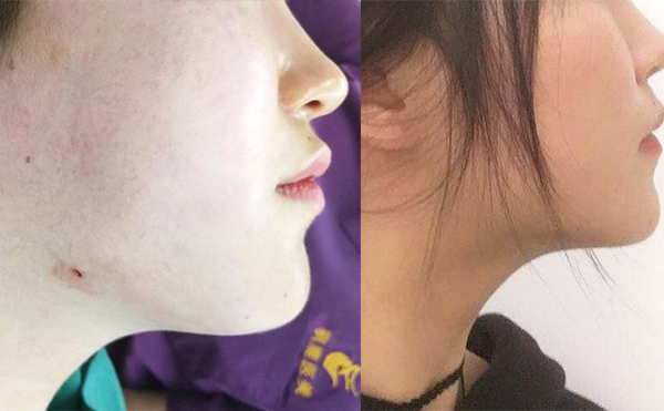 面部吸脂恢復(fù)期多長(zhǎng)時(shí)間？