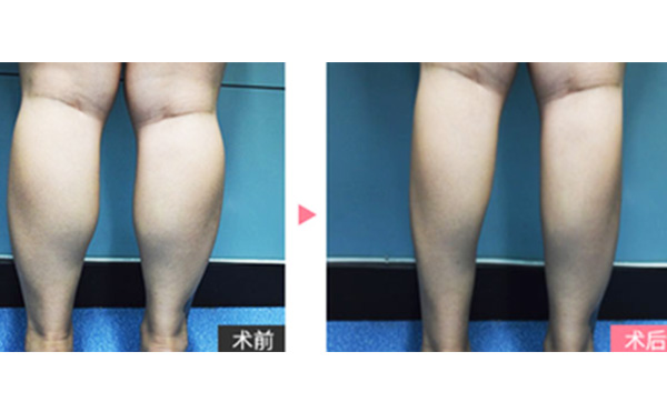 boxo瘦腿有什么優(yōu)勢？
