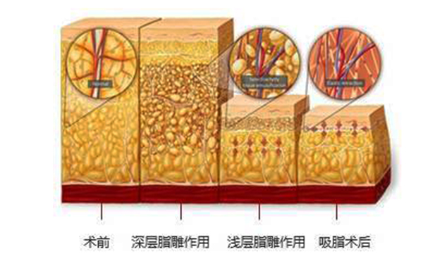 韓式分層吸脂的效果怎么樣？