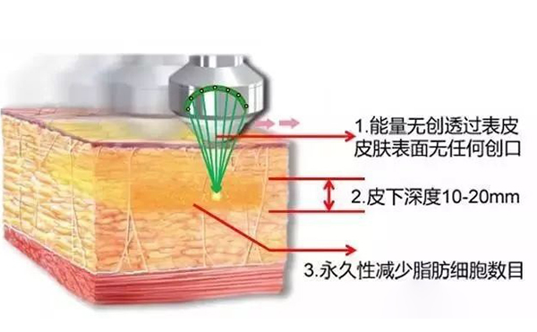 超聲波吸脂怎么瘦手臂？