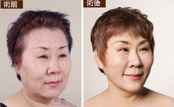 拉皮手術(shù)多久能恢復(fù)自然？