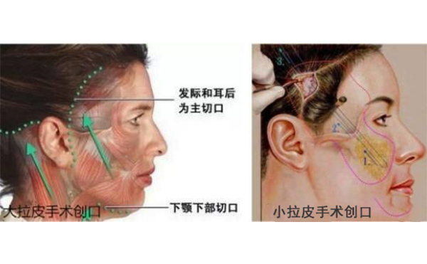 小拉皮和傳統(tǒng)拉皮有什么區(qū)別？
