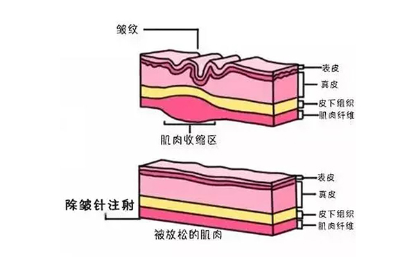 注射除皺是什么原理？