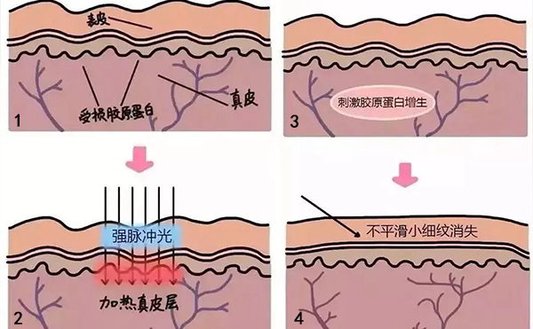 光子嫩膚去魚(yú)尾紋