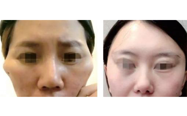 筋膜懸吊除皺有什么副作用？
