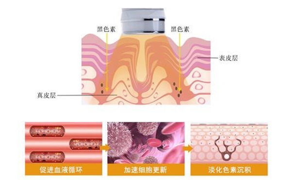 光子嫩膚效果好不好？