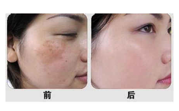 光子嫩膚有什么優(yōu)勢(shì)？