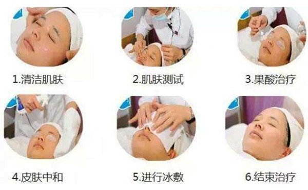 果酸煥膚的過程是什么？