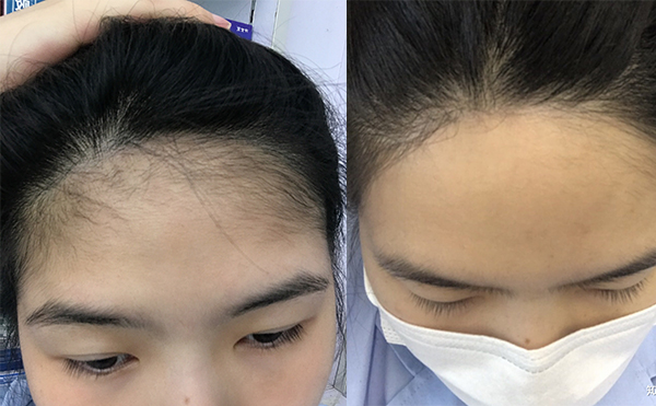 激光脫發(fā)際線的過程是什么？