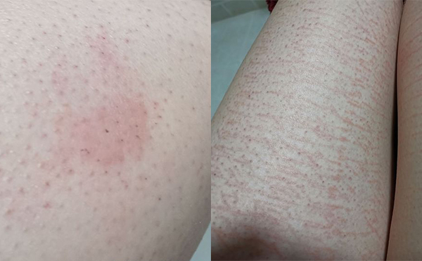 錯(cuò)誤脫毛有什么后果？