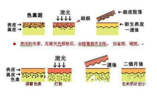 光子嫩膚和皮秒有什么區(qū)別？