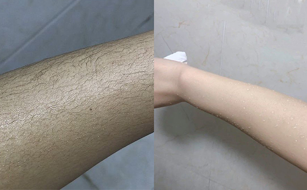 冰點手臂脫毛