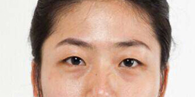 光纖溶脂祛眼袋術前