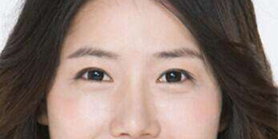 光纖溶脂祛眼袋術后
