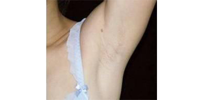 脫腋毛術后