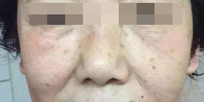 精華導入術后