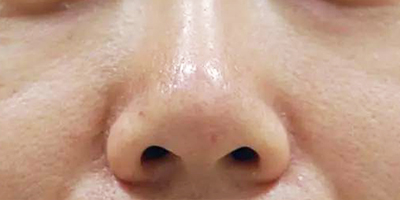 小棕瓶美白術后