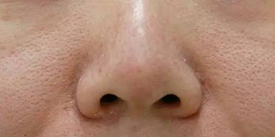 小棕瓶美白術前