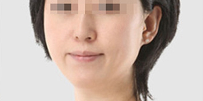 超聲提升術后