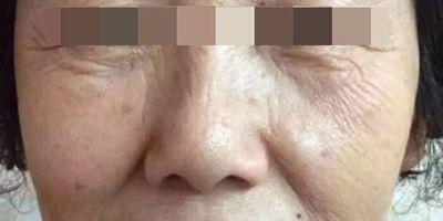 精華導入術前