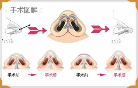 縮鼻頭手術(shù)可以保持多久？縮鼻頭手術(shù)術(shù)后注意事項？